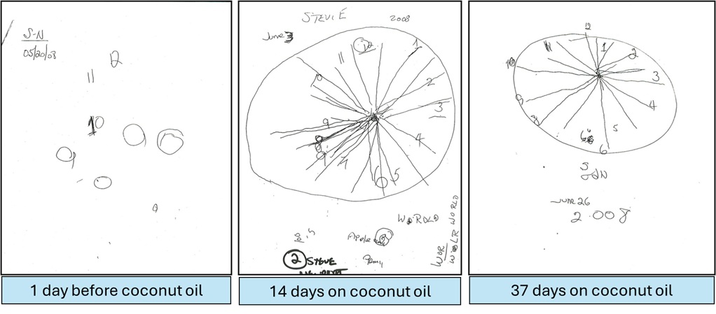 Steve Newport's clock drawings the day before and 14 and 37 days after starting coconut oil