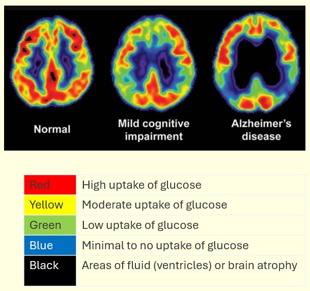 brain glucose uptake in normal, MCI, Alzheimer's 